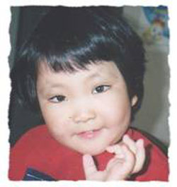 Kabuki make-up syndrome Kabuki (4).jpg